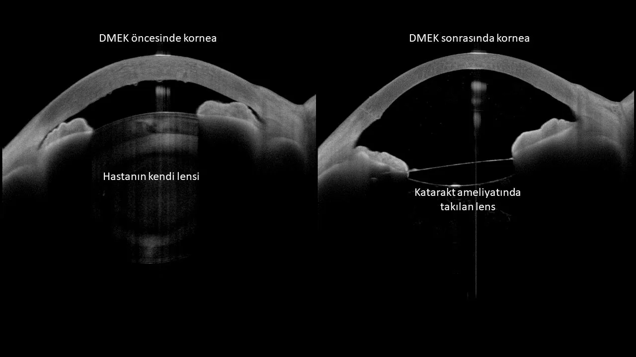 Katarakt ve endotel yetmezliği olan bir gözde üçlü işlem öncesi ve sonrası ön segment optik koherens tomografi kesiti