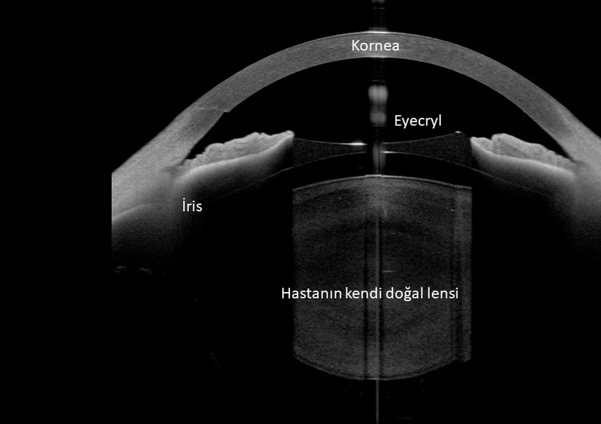 Eyecryl takılmış bir gözün ANTERION ön segment OCT kesiti, görüntü üzerinde kornea, iris, Eyecryl ve hastanın kendi doğal merceği etiketli