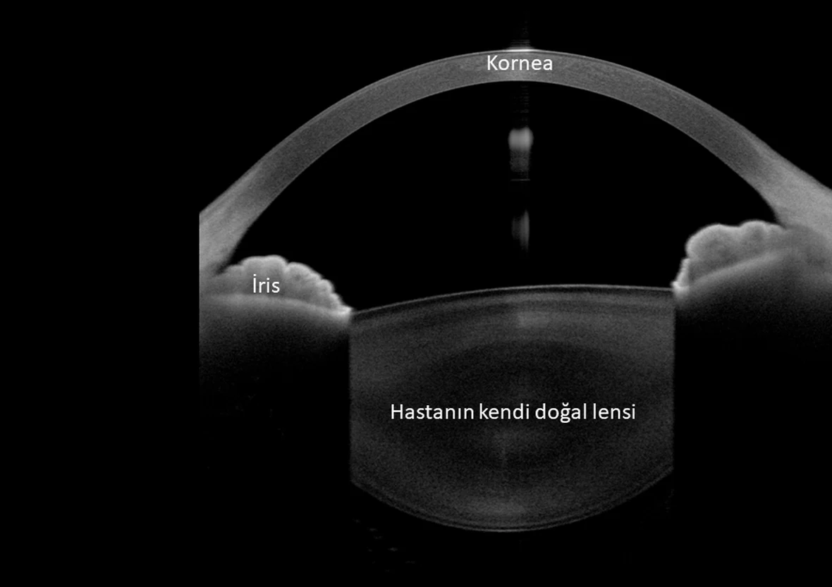 Fakik göz içi merceği takılmamış bir gözün ANTERION ön segment OCT kesiti, görüntü üzerinde kornea, iris ve hastanın kendi doğal merceği etiketli