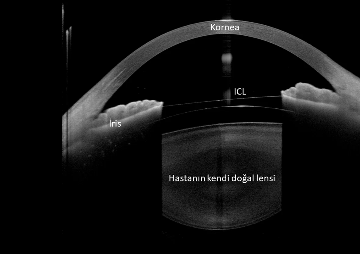 ICL takılmış bir gözün ANTERION ön segment OCT kesiti, görüntü üzerinde kornea, iris, ICL ve hastanın kendi doğal merceği etiketli