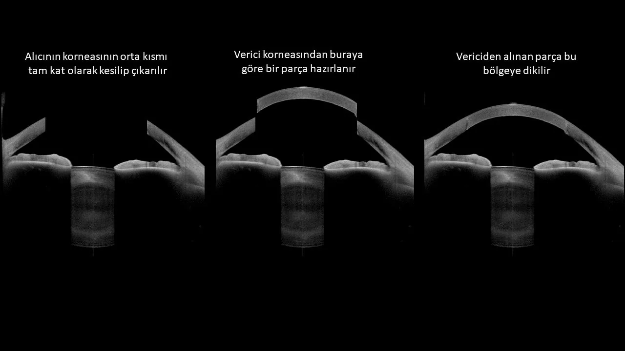 Penetran keratoplastinin üç aşaması: soldaki iki panel şematik gösterim, sağdaki panel ameliyat sonrası çekilmiş gerçek ön segment optik koherens tomografi kesiti